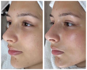 Multi Face One - junge Frau vor und nach der Behandlung, mit mehr Glow